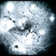Central Serous Chorioretinopathy 8